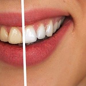 Tooth-2414909_640
